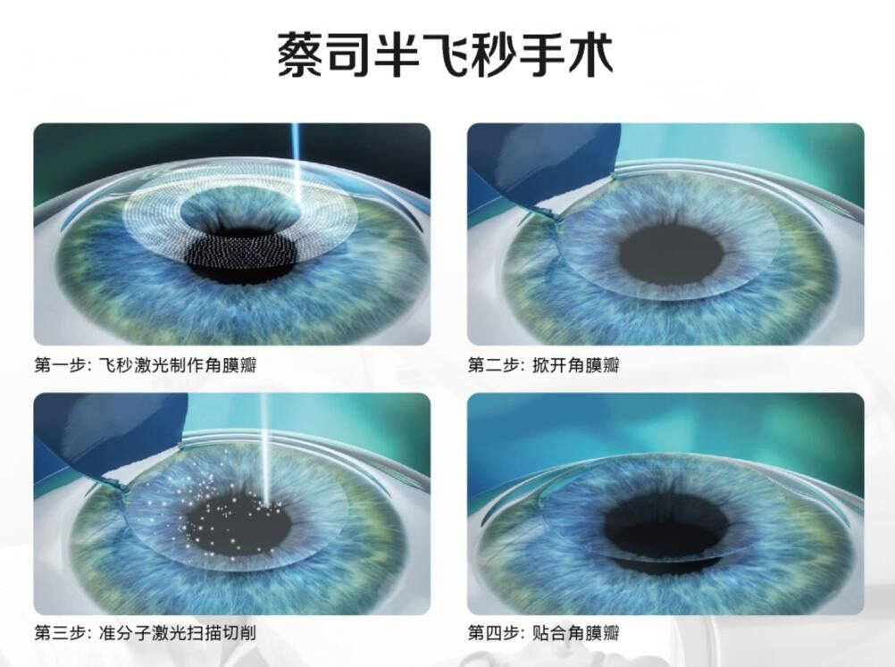 蔡司全飛秒、蔡司半飛秒近視手術與蔡司全飛秒flex手術