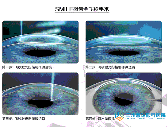 蘭州全飛秒激光近視手術無瓣(smile)技術