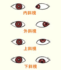 看看兒童斜視眼病怎么預防？